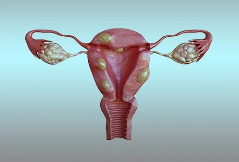 adenomyosis-vs-uterine-fibroids
